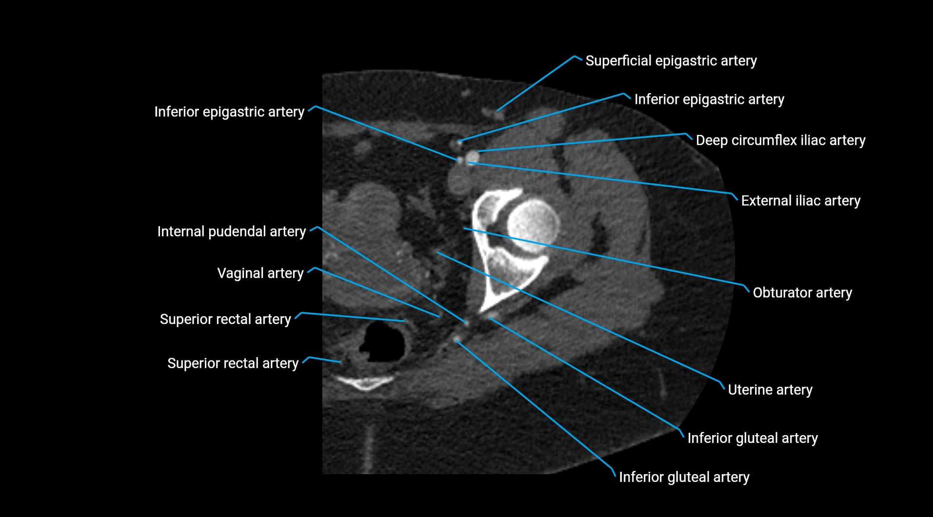 CTA lower limb cross sectional anatomy labelled image _50.webp